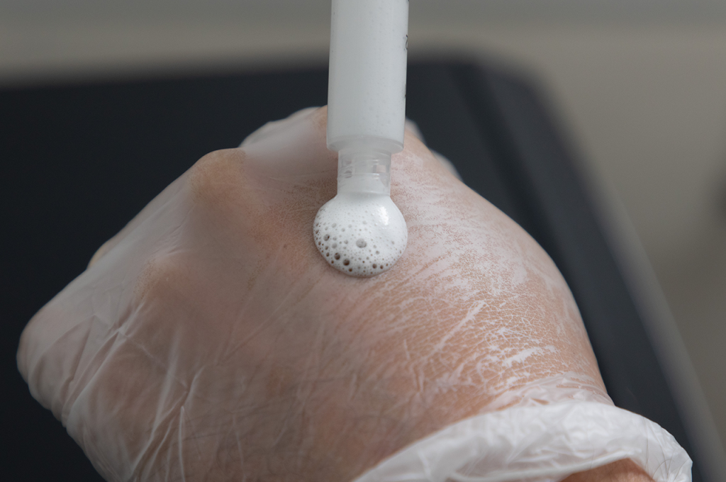 Uma mão enluvada recebe uma substância semelhante a uma espuma dispensada de um tubo no dorso da mão, ilustrando a escleroterapia com espuma, um tratamento comum de varizes para cuidados com a pele ou tratamento médico eficaz.