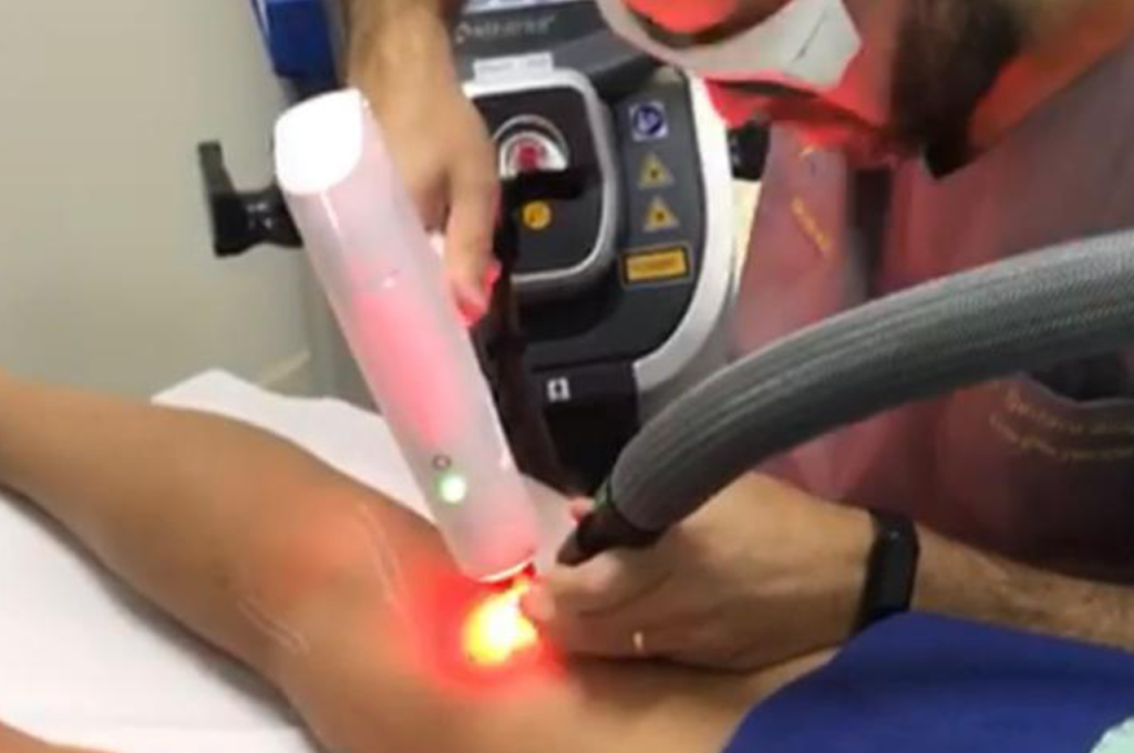 Uma pessoa está recebendo um tratamento de depilação a Laser Transdérmico no braço por um profissional usando equipamento especializado, com uma luz laser vermelha visível no ponto de contato.